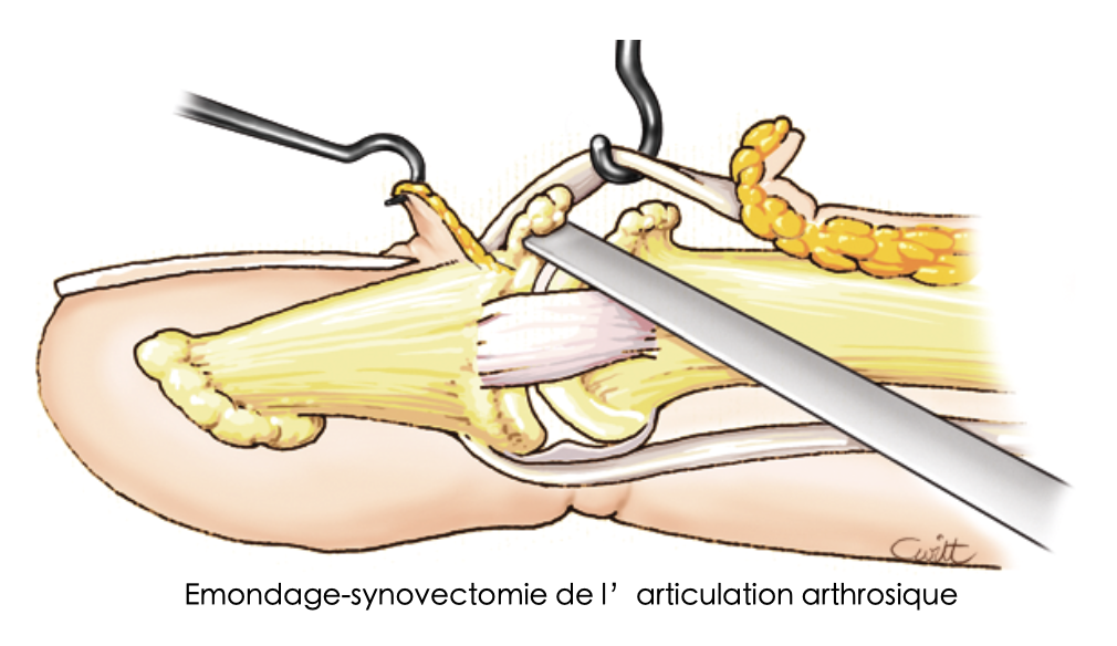 Émondage-synovectomie