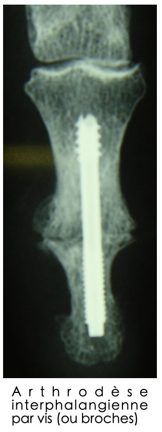 Arthrodèse interphalangienne