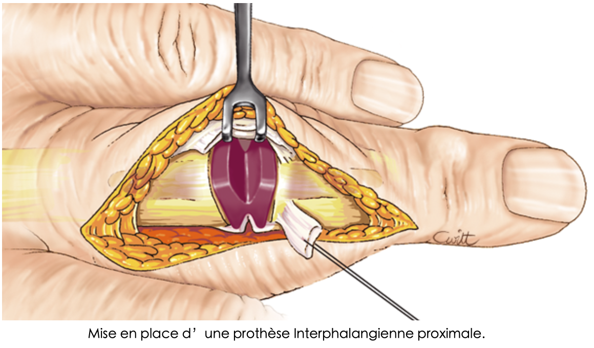 Prothèse interphalangienne