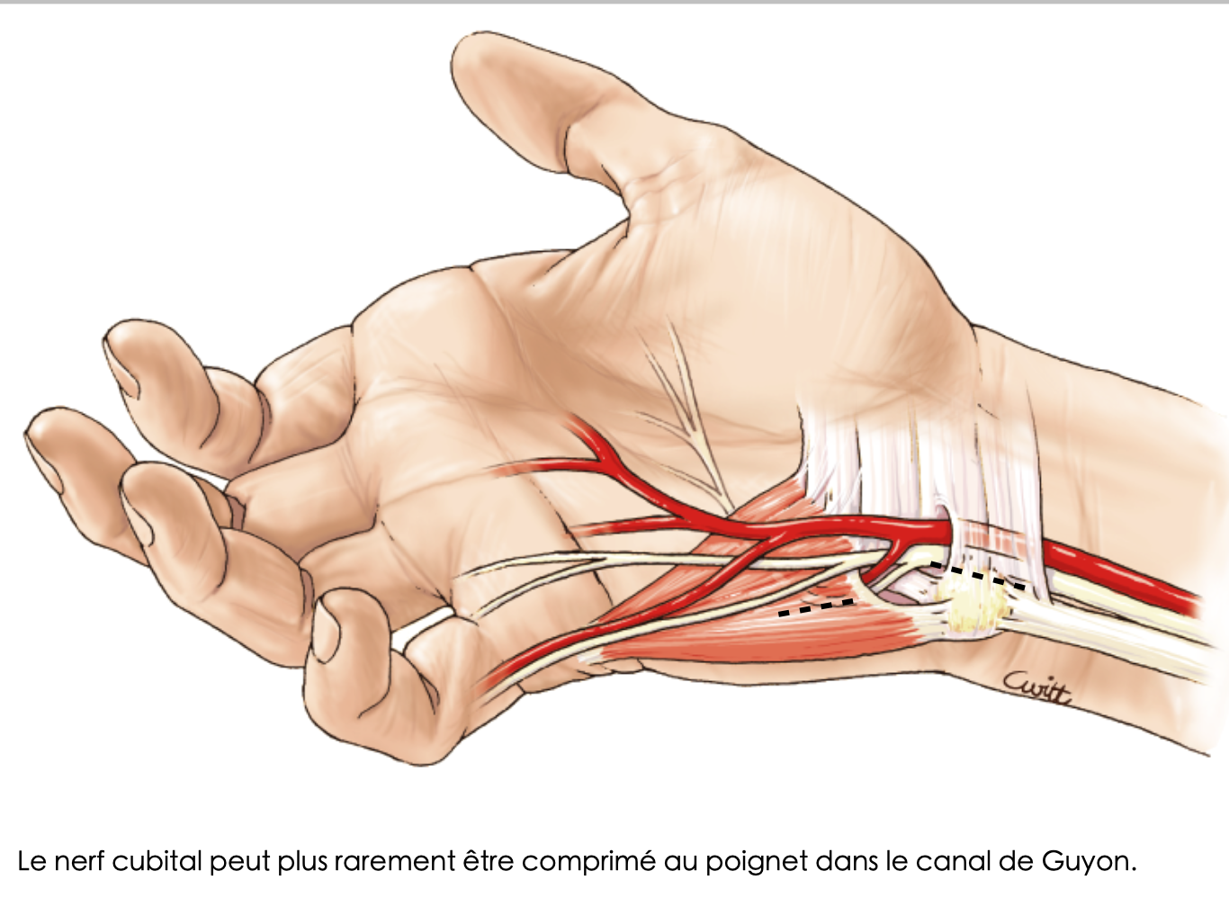 Compression du nerf cubital au coude