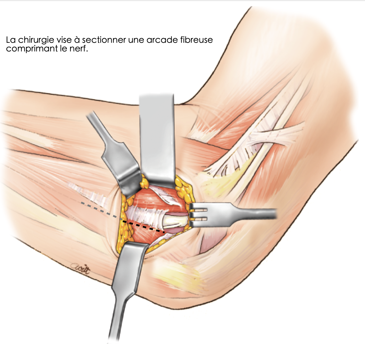 Canal de Guyon au poignet