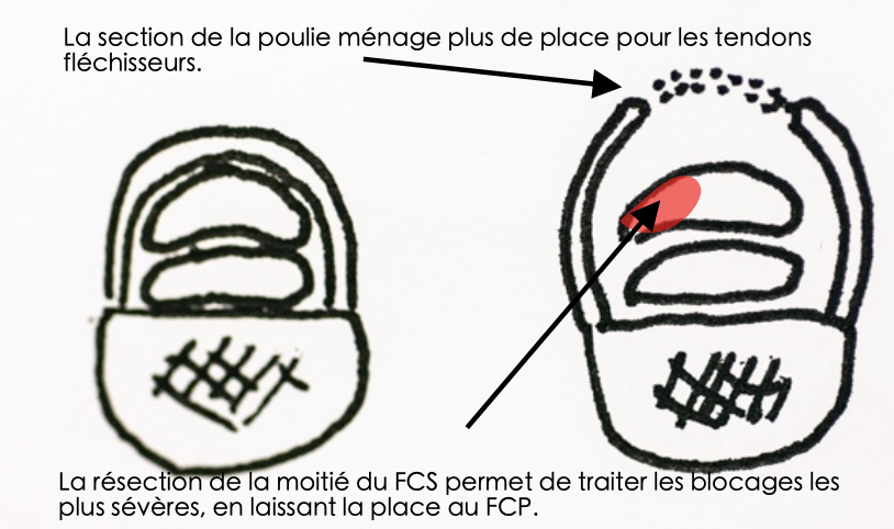 Anatomie doigt à ressaut
