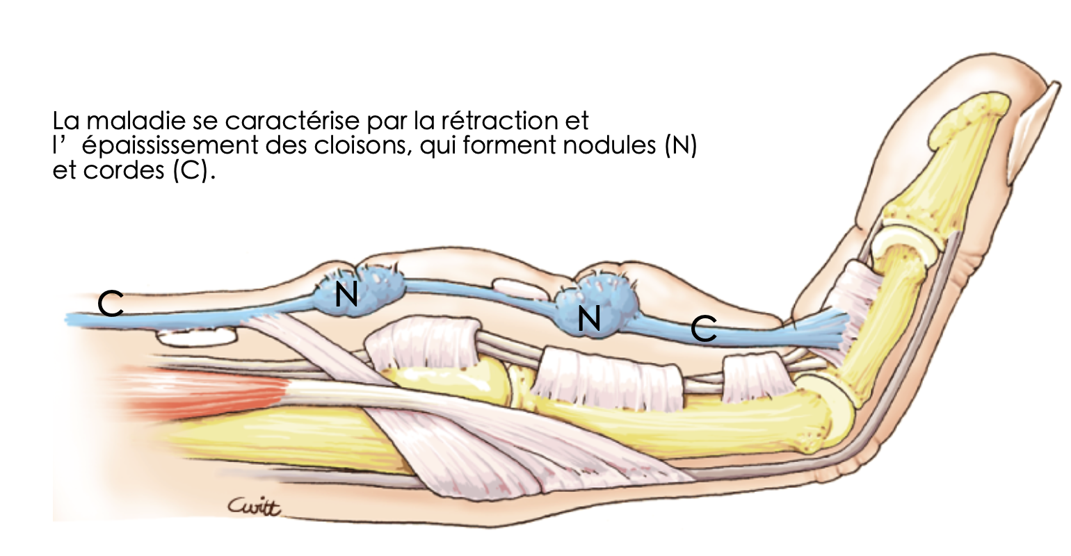 Maladie de Dupuytren avec nodules et cordes