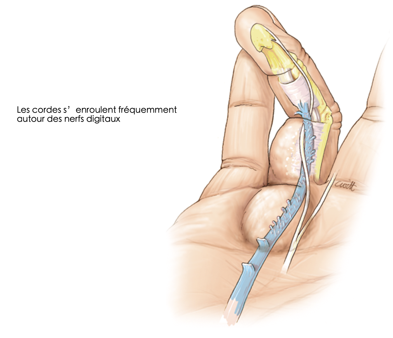 Incision classique Dupuytren