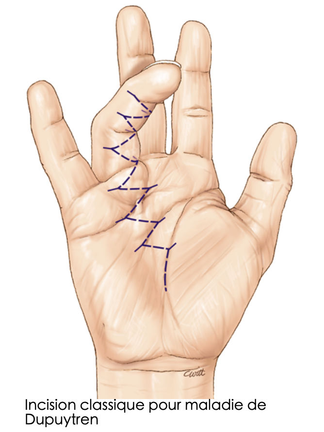 Cordes enroulées autour des nerfs