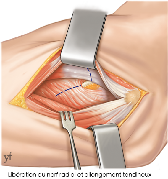 Chirurgie épicondylite