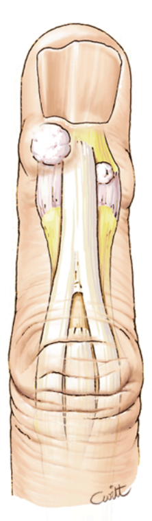 Kystes interphalangienne distale