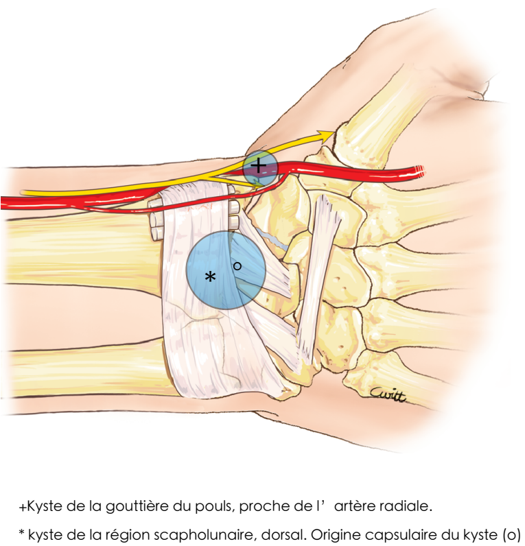 Kystes du poignet