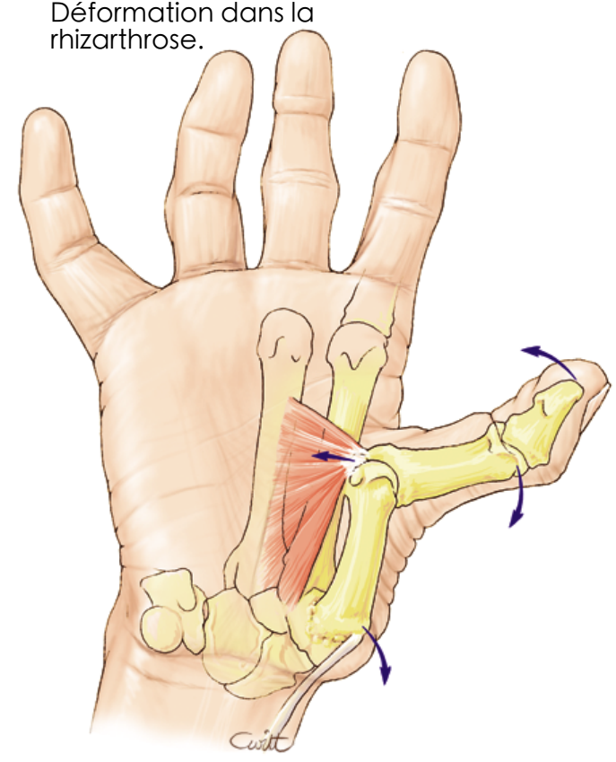 Déformation rhizarthrose
